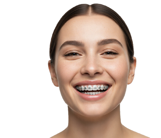 Установка брекет-системы под ключ!