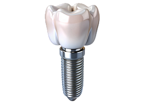 Имплантация зуба «под&nbsp;ключ»