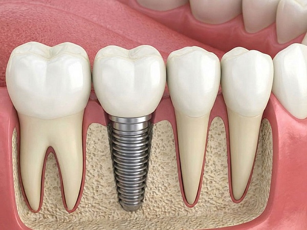 Протезирование на имплантах