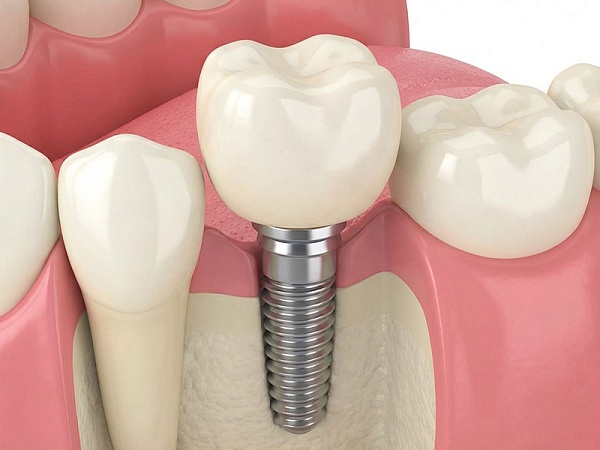 Протезирование