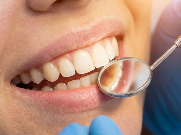 Плазмолифтинг в стоматологии