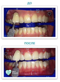 Отбеливание зубов