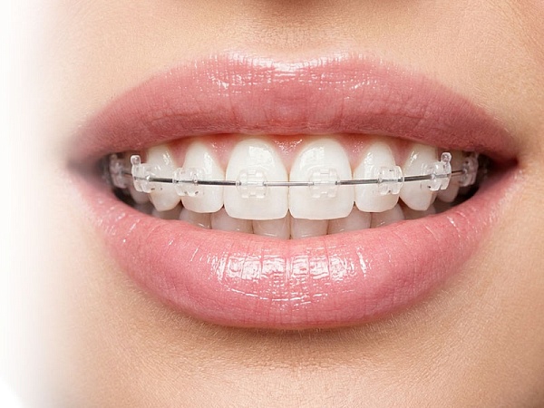 Самолигируемые брекет-системы
