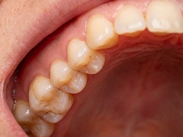 Чистка пародонтальных карманов