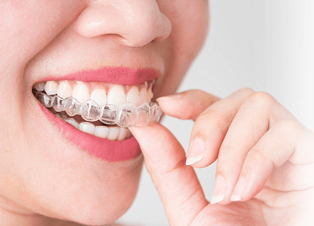 Капы ортодонтические Invisalign