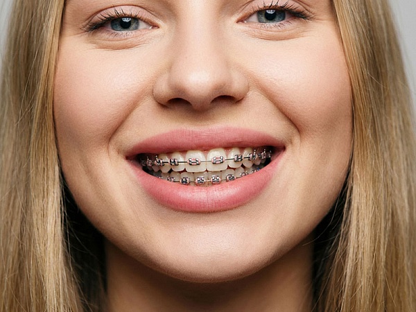 Лигатурные брекеты