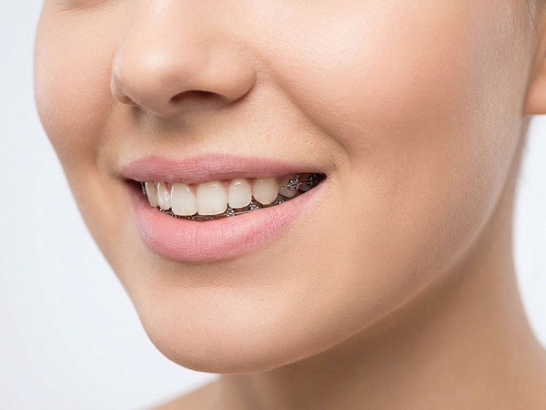 Лингвальные брекеты