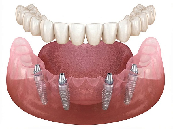 Имплантация All-on-4
